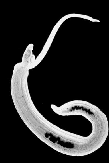 This was a case of schistosomiasis caused by Schistosoma mansoni.