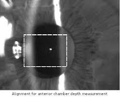Anterior Chamber Depth Many of the IOL calculation formulas use ACD as part of calculation IOL master uses a projected slit beam to
