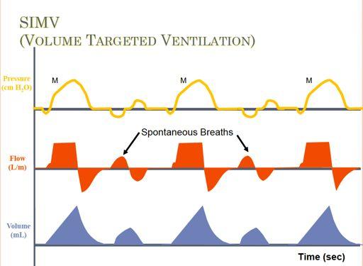 7 C HAPTER Synchronous intermittent mandatory ventilation (SIMV) 7 30/01/2012 SIMV is a mixed ventilatory mode that allows both mandatory and spontaneous breaths.