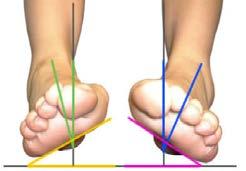 Varus forefoot A supinated forefoot Varus Forefoot Valgus Rearfoot Varus Forefoot Valgus Rearfoot Supinated Forefoot One accompanies the other.