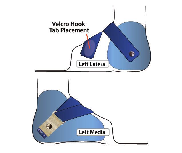 y Allows you to try using the brace without a forefoot strap. Request in Special Instructions section of order form (e.g., Layover forefoot strap with no rivet ).