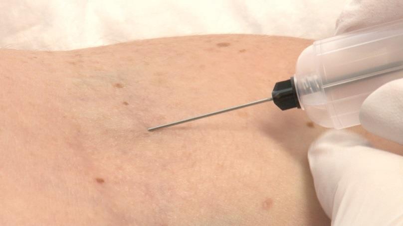 A loss of resistance will be felt when the needle enters the vein Advance needle tip 1-2mm into vein, and reduce the angle with the skin Do NOT dig with your needle.