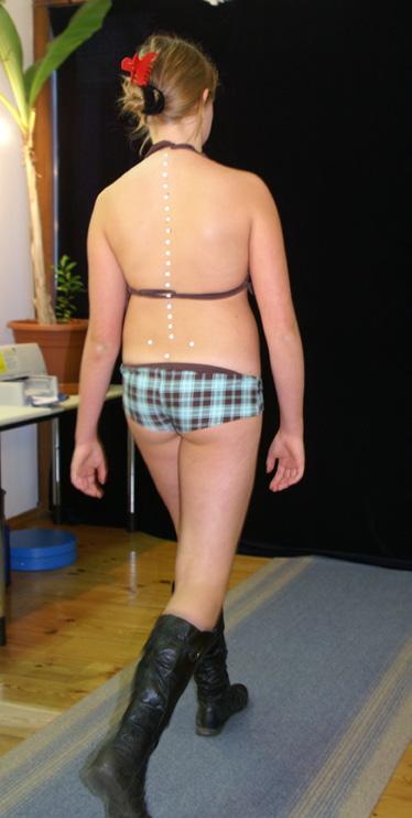 This does not mean that the scoliosis had disappeared, but the girl had succeded in straightening her upper body. Fig.