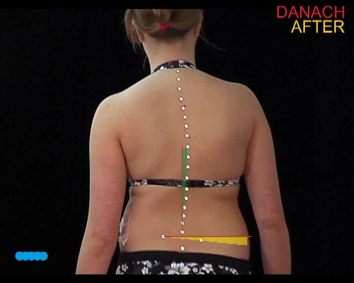 Before: In connection to the pelvis angles the lumbar spine deviation rises from 1 in standing position to 16 in the right step and 12 in the left step.