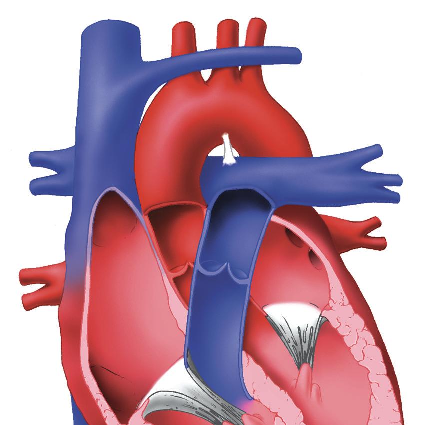 Superior vena cava (from upper body) Right atrium Right ventricle Aorta (to body) Left atrium Figure 1.