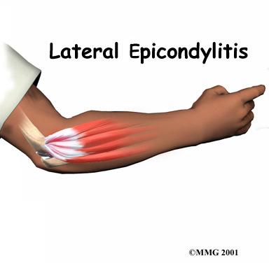 Introduction Lateral epicondylitis, commonly known as tennis elbow, is not limited to tennis players.