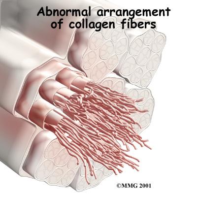 In tendinosis, wear and tear is thought to lead to tissue degeneration. A degenerated tendon usually has an abnormal arrangement of collagen fibers.