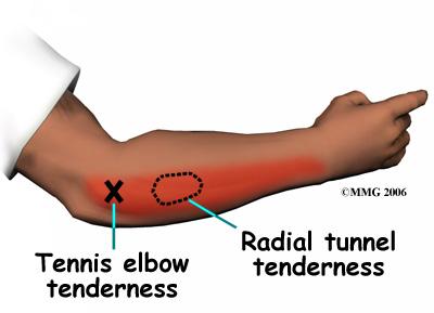 nerve as it crosses the elbow. If your pain does not respond to treatments for tennis elbow, your doctor may suggest tests to rule out problems with the radial nerve.