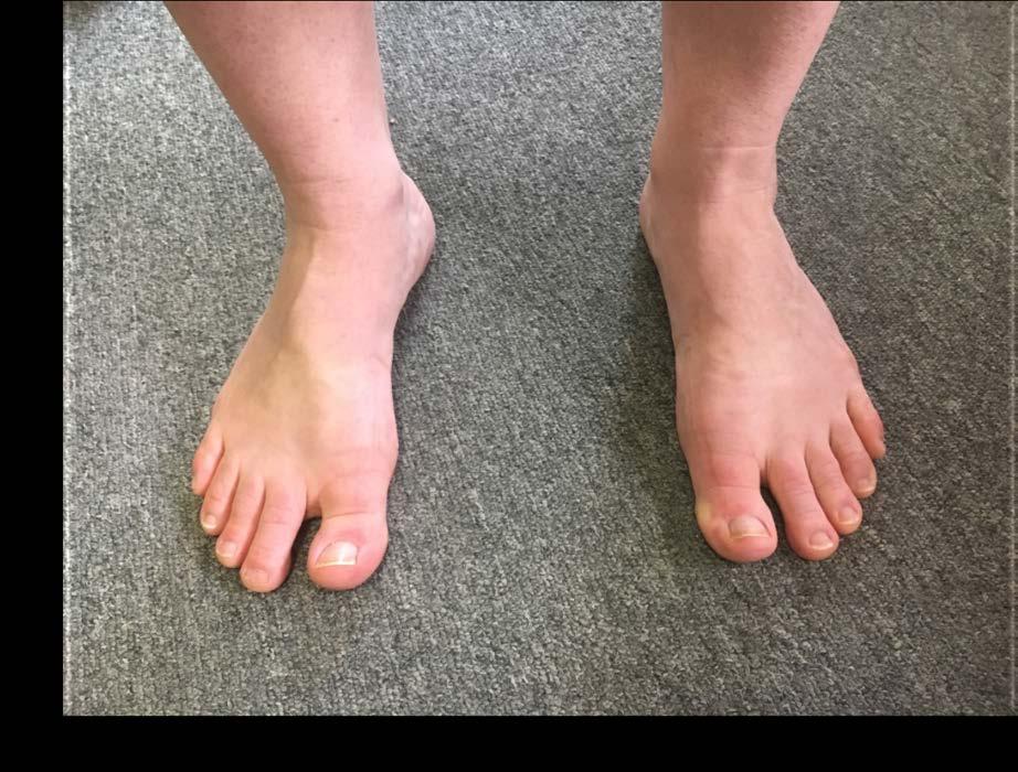 Dynamic Feet Appearance Strong Intrinsic Muscles Gap