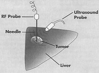 Page 2 Radiofrequency Ablation to Treat Solid Tumors How is the procedure done? The procedure is done by an interventional radiologist, a doctor who specializes in this type of procedure.