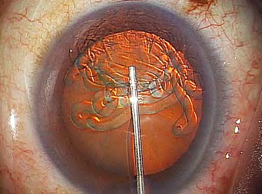 Corneal Protection Fill up the anterior