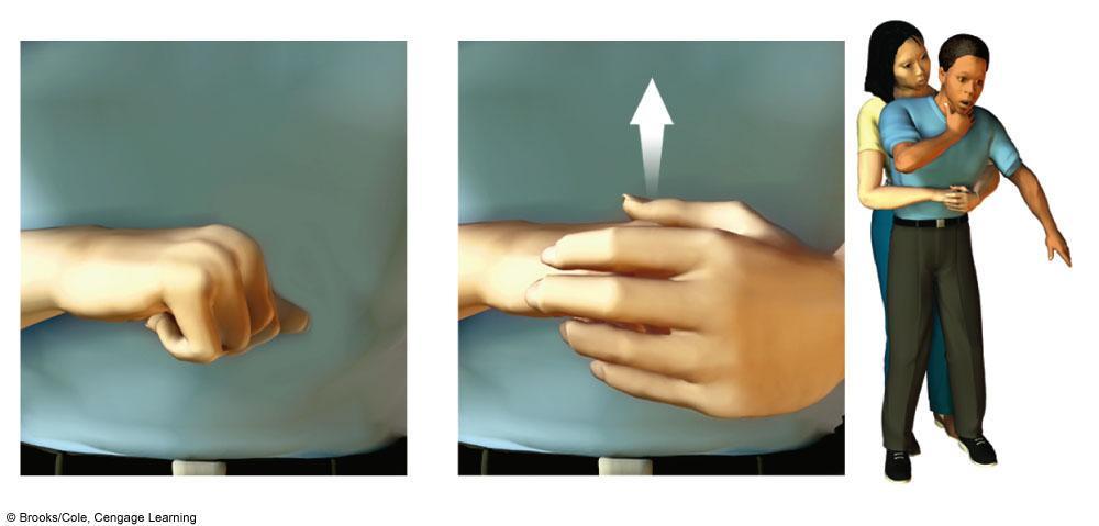 First Aid for Choking Heimlich maneuver Upward-directed force on