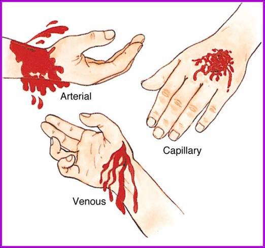 Take 5 Unit 3 Disaster Medical Operations Part 1 3-30 Types of Bleeding Arterial bleeding!