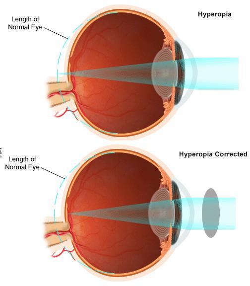 To correct nearsighted eyes (myopia), you use concave lenses They move the focal point backward To