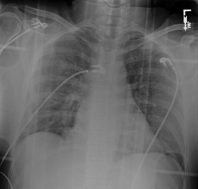 46 year old unrestrained female MC fractures right radial, ulnar, fibula left ankle pelvis contusion RML CT head & spine negative patient c/o left chest pain vital signs unstable Case
