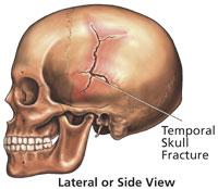 Skull Fracture Another exception is a scalp injury that involves a depressed segment.