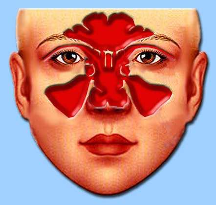 Sinus Block If an ascent or descent is made too quickly, or if the openings to the sinuses are