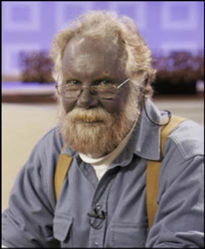 Argyria Blue man case #2 A 34 year old HIV+ woman presents with c/o feeling lightheaded, nauseated, and short of breath.