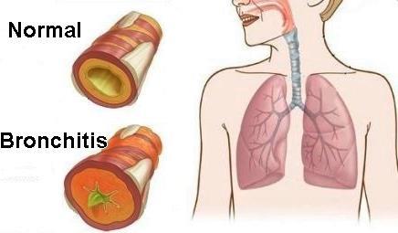 gaseous exchange - Symptoms : breathing difficulty, tiredness, excessive coughing Bronchitis - Inflammation of the epithelium (cell layer) of the bronchus - Causes by fine particles