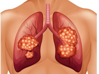 pains, continuously heavy coughing, phlegm changes from white to yellow or green Lung Cancer - Caused by unusual cell growths in the lungs and smoking is a major cause because of its