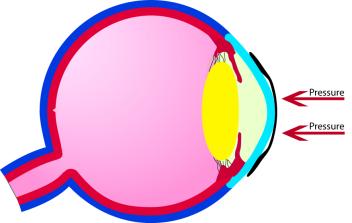 Use an eye graphic or hand drawing of the eye and show how light focuses in front of the retina in a nearsighted eye.