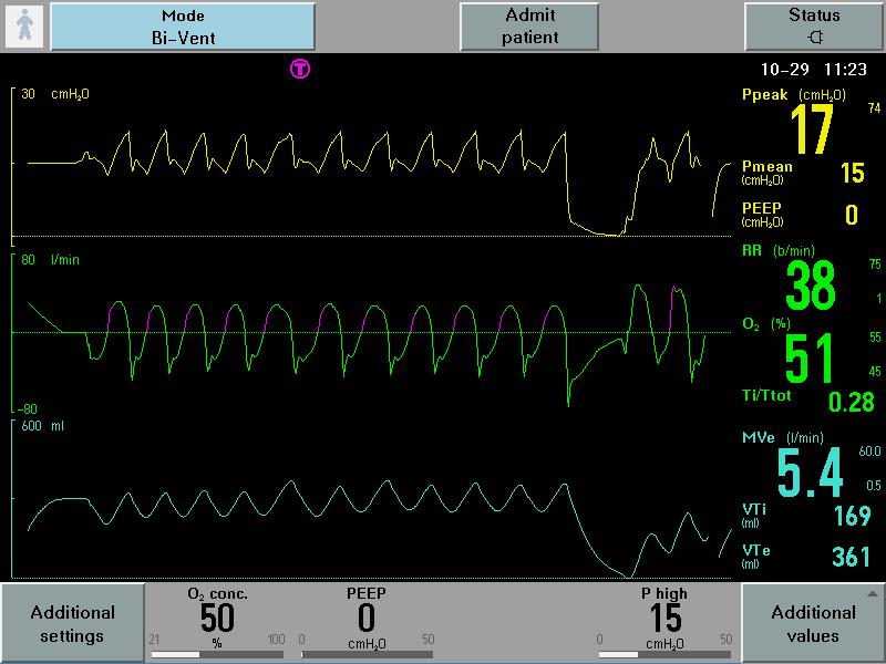 BI-VENT (APRV) PARAMETERS: WEANING GRAPHICS Spontaneous Breaths BI-VENT (APRV) SUMMARY When ventilation improves, T high can be increased When oxygenation improves, P high can be decreased When