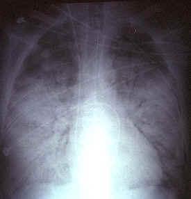 ARDS Catastrophic pulmonary or non-pulmonary event resulting in ALI & respiratory failure Increased intrapulmonary shunt