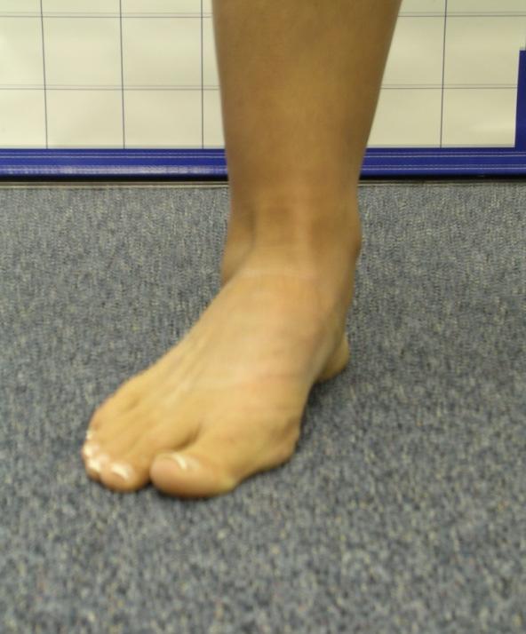 FEET: flatten Arch Drops Normal Abnormal Note: the arch will drop or appear to flatten and the lateral border may also appear to