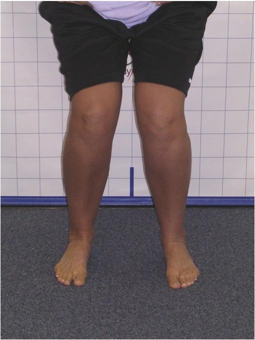 KNEES: move inwards Normal Abnormal Note: The knee would be observed to move inward if the