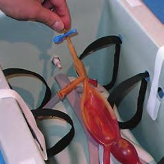 Removing the AAA 4 X 5 To manage Mock Blood to and from the secondary tube align the OFF arm of the valve with the primary tube.