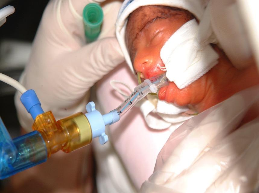 Figure 1: An intubated neonate receiving full ventilator support Ventilator modes The actual terminology of available modes used may differ between makes and models of different ventilators which