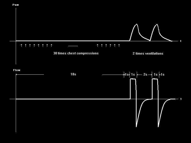 CPR for mask ventilated patients On screen chest compressing animation On