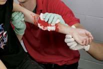 Bleeding Control Use pressure dressings if direct pressure does