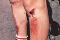 Open Soft Tissue Injuries Abrasions Epidermis & part of dermis