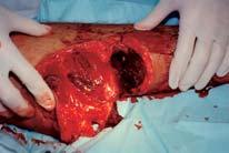 Open Soft Tissue Injuries Lacerations Tear in skin Bleeding