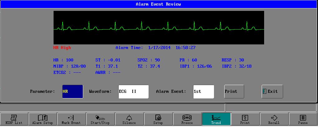 ALARM EVENT In this window, you can recall the alarm information. It includes the parameter s waveform and value exceeds the limits.
