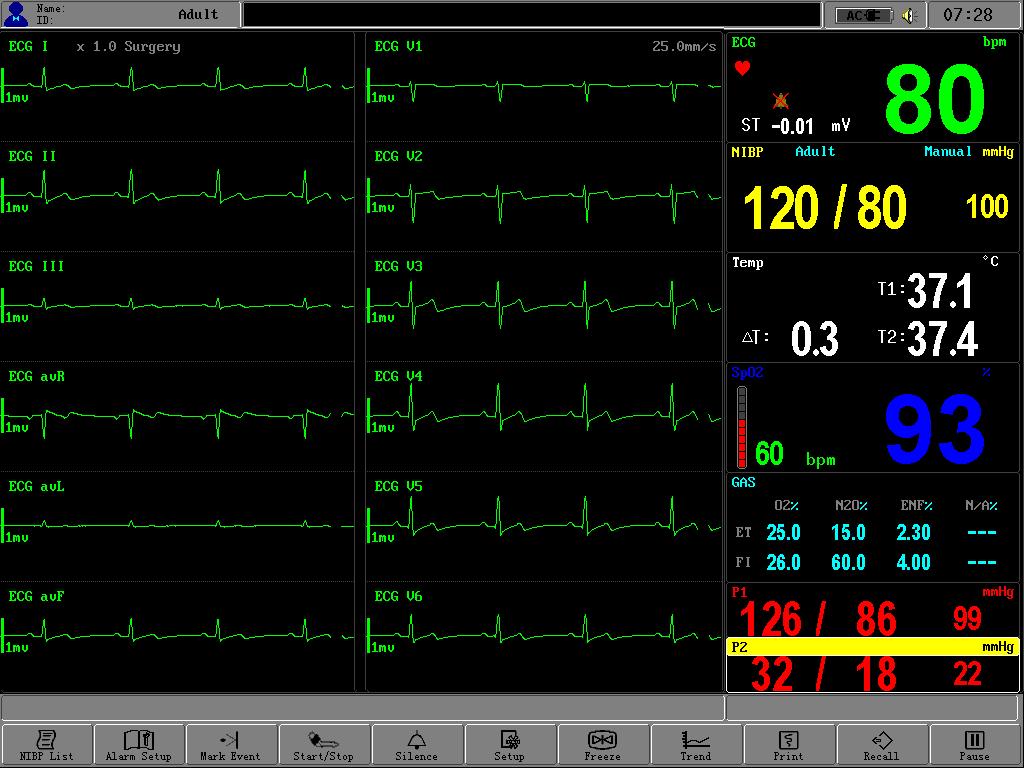 Figure 16: Window for Full 12-Lead ECG ERROR MESSAGES OF ECG MONITORING Sometimes messages will display above the ECG waveform: Prompts Lead off ECG Signal Weak Explanation ECG leads fall off the
