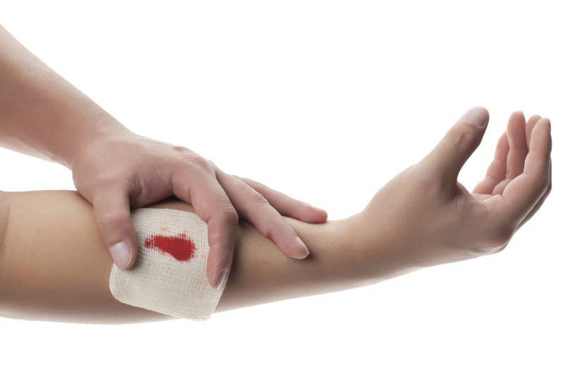 Control of Bleeding Blood vessels are present throughout the body, bleeding occurs when tissues are damaged. Bleeding reduces the oxygen carrying capacity of the blood.