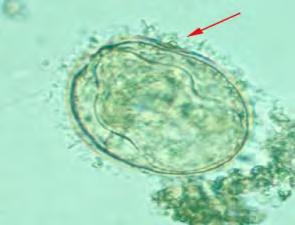 Schistosoma haematobium eggs are released in