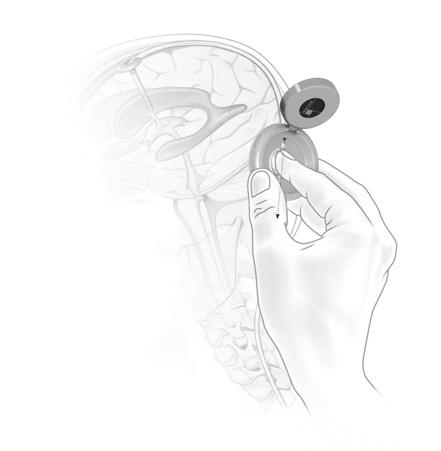 INSTRUCTIONS FOR USE 1. Locating the valve If the instrument is opened a template is visible (fig. 9). Then the valve can be located on the patient s head with the forefinger. Fig.