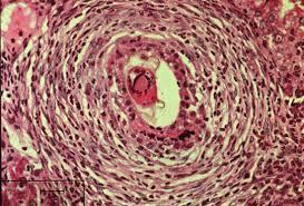 Figure 12: Schistosome egg granuloma in human