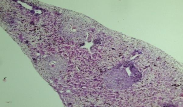 a) b) Figure 25: Liver of mice infected with cercariae of only S.