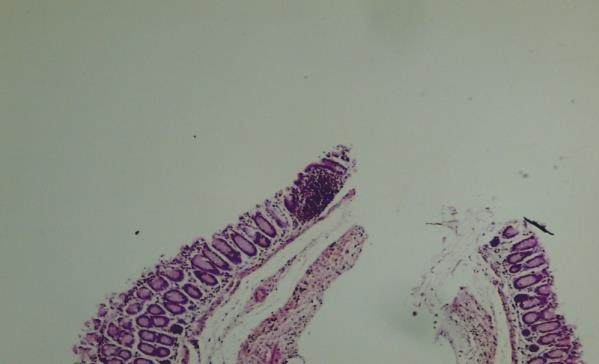 Arrows indicate granulocytes surrounding a worm.