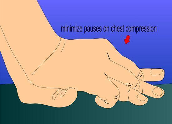 11 Minimize pauses in chest compression that occur when changing providers or preparing for a shock.