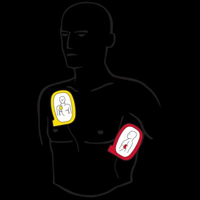 Follow Voice Prompts Follow AED voice commands until emergency medical personnel arrive.