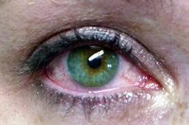Ammonia Exposure Causes severe burns to the eyes, nose, throat and skin.