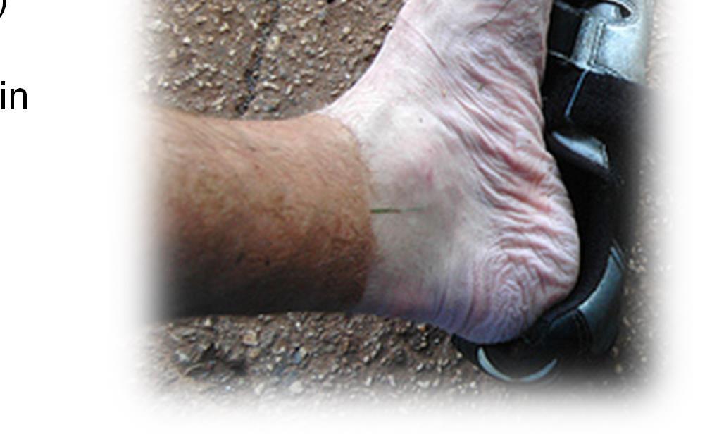 Immersion Foot Also known as trench foot and generally occurs after prolonged exposure to cold water Common in hikers or hunters who stand a long time in a river or lake May be seen in urban settings
