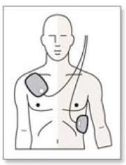 Option 2: Anteroposterior Place one AED pad on the left side of the chest, between the victims left side of the breastbone and the nipple Place the other pad on the left side of the victim s back,