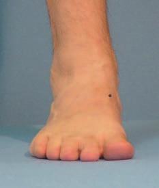 Materials and Methods A pilot study was undertaken to examine the relationship between arch height and length relative to dorsiflexion of the great toe during full weight bearing.