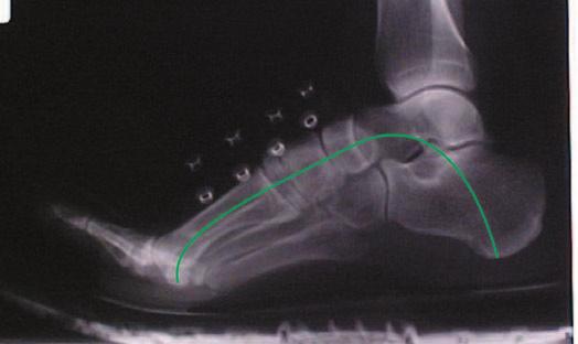 4) shod with a custom orthotic (posted to four degrees at rearfoot and six degrees at forefoot).